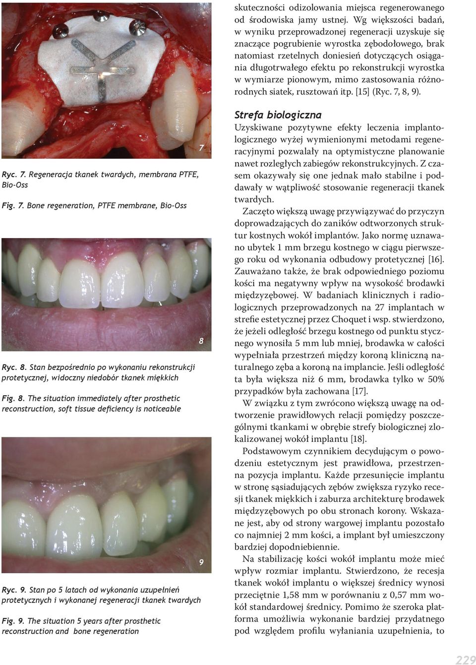 rekonstrukcji wyrostka w wymiarze pionowym, mimo zastosowania różnorodnych siatek, rusztowań itp. [15] (Ryc. 7, 8, 9). Ryc. 7. Regeneracja tkanek twardych, membrana PTFE, Bio-Oss Fig. 7. Bone regeneration, PTFE membrane, Bio-Oss Ryc.