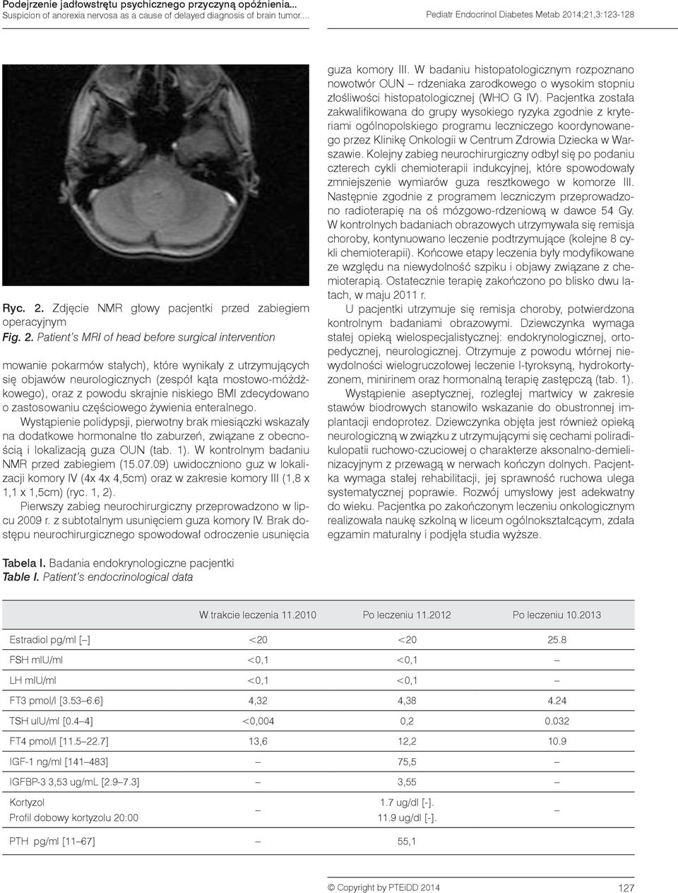 Patient s MRI of head before surgical intervention mowanie pokarmów stałych), które wynikały z utrzymujących się objawów neurologicznych (zespół kąta mostowo-móżdżkowego), oraz z powodu skrajnie
