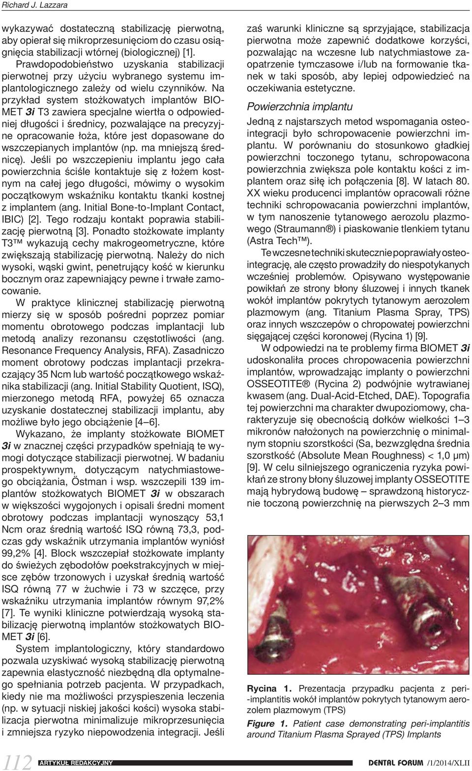 Na przykład system stożkowatych implantów BIO- MET 3i T3 zawiera specjalne wiertła o odpowiedniej długości i średnicy, pozwalające na precyzyjne opracowanie łoża, które jest dopasowane do