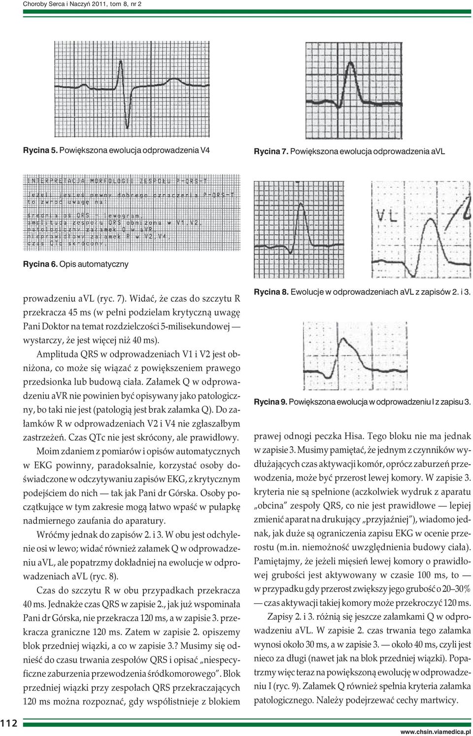 Amplituda QRS w odprowadzeniach V1 i V2 jest obniżona, co może się wiązać z powiększeniem prawego przedsionka lub budową ciała.