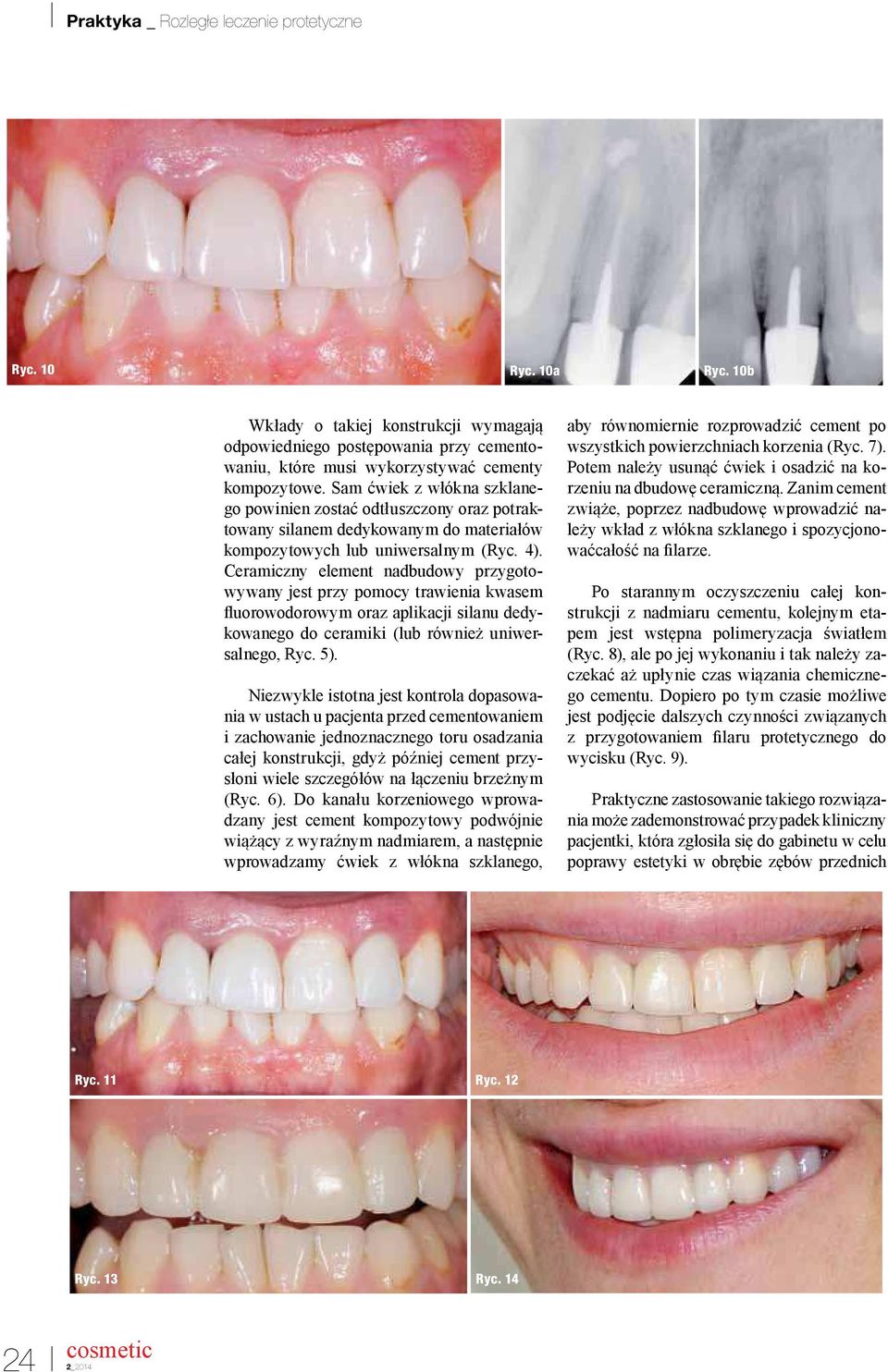 Ceramiczny element nadbudowy przygotowywany jest przy pomocy trawienia kwasem luorowodorowym oraz aplikacji silanu dedykowanego do ceramiki (lub również uniwersalnego, Ryc. 5).