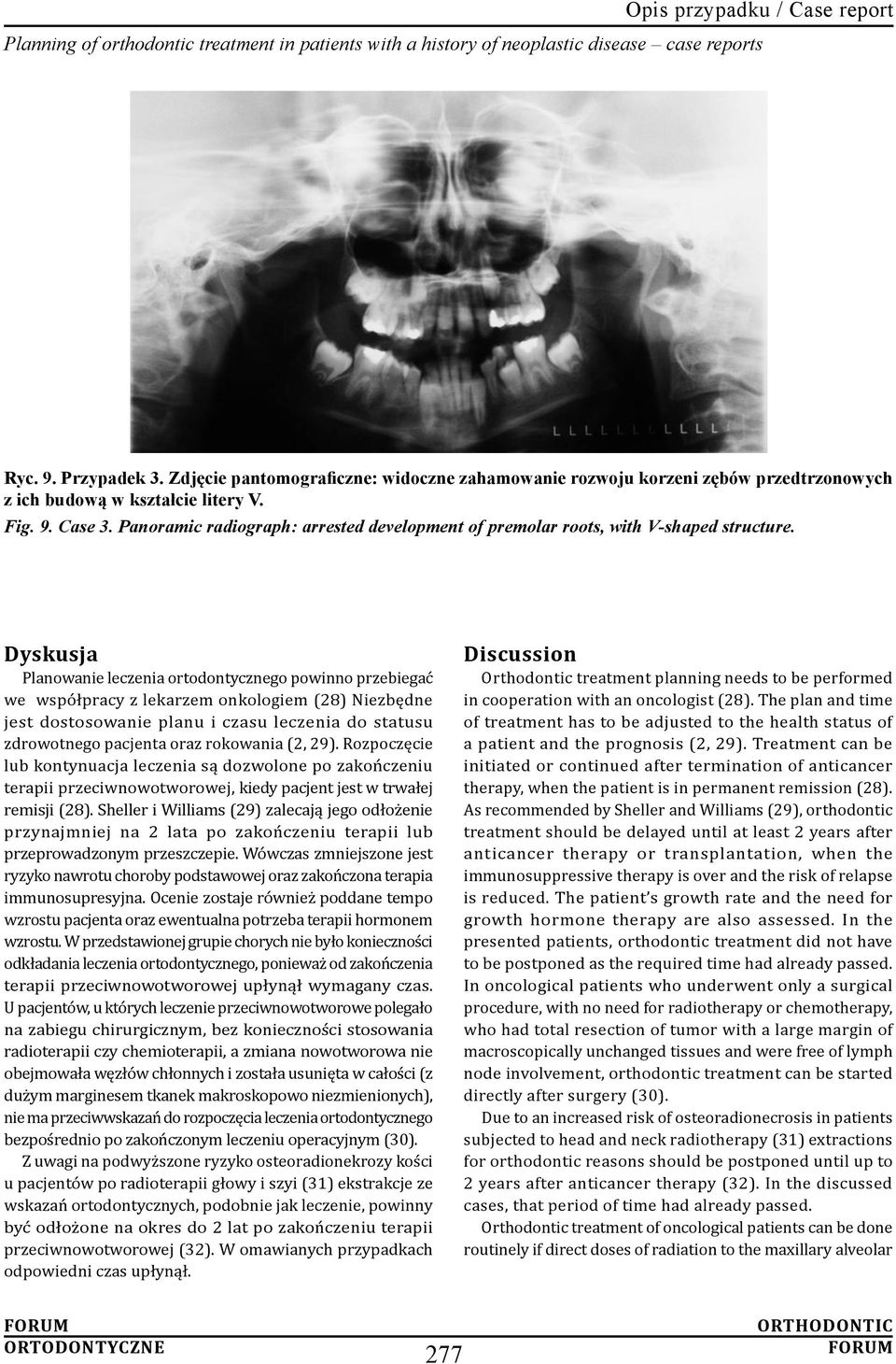 Dyskusja Planowanie leczenia ortodontycznego powinno przebiegać we współpracy z lekarzem onkologiem (28) Niezbędne jest dostosowanie planu i czasu leczenia do statusu zdrowotnego pacjenta oraz