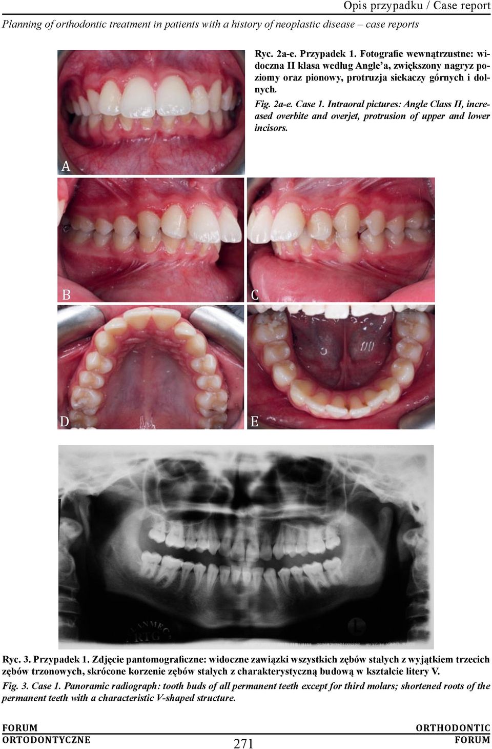 Zdjęcie pantomograficzne: widoczne zawiązki wszystkich zębów stałych z wyjątkiem trzecich zębów trzonowych, skrócone korzenie zębów stałych z charakterystyczną budową w