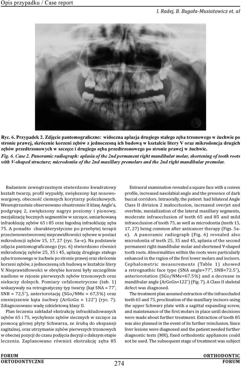 zębów przedtrzonowych w szczęce i drugiego zęba przedtrzonowego po stronie prawej w żuchwie. Fig. 6. Case 2.