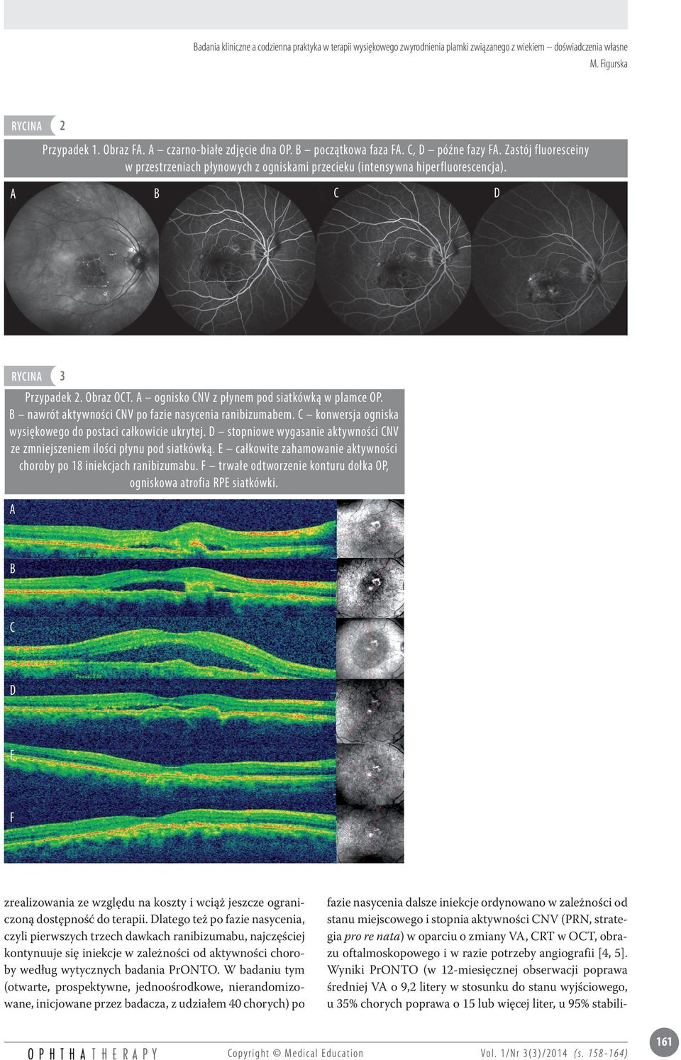 A ognisko CNV z płynem pod siatkówką w plamce OP. B nawrót aktywności CNV po fazie nasycenia ranibizumabem. C konwersja ogniska wysiękowego do postaci całkowicie ukrytej.