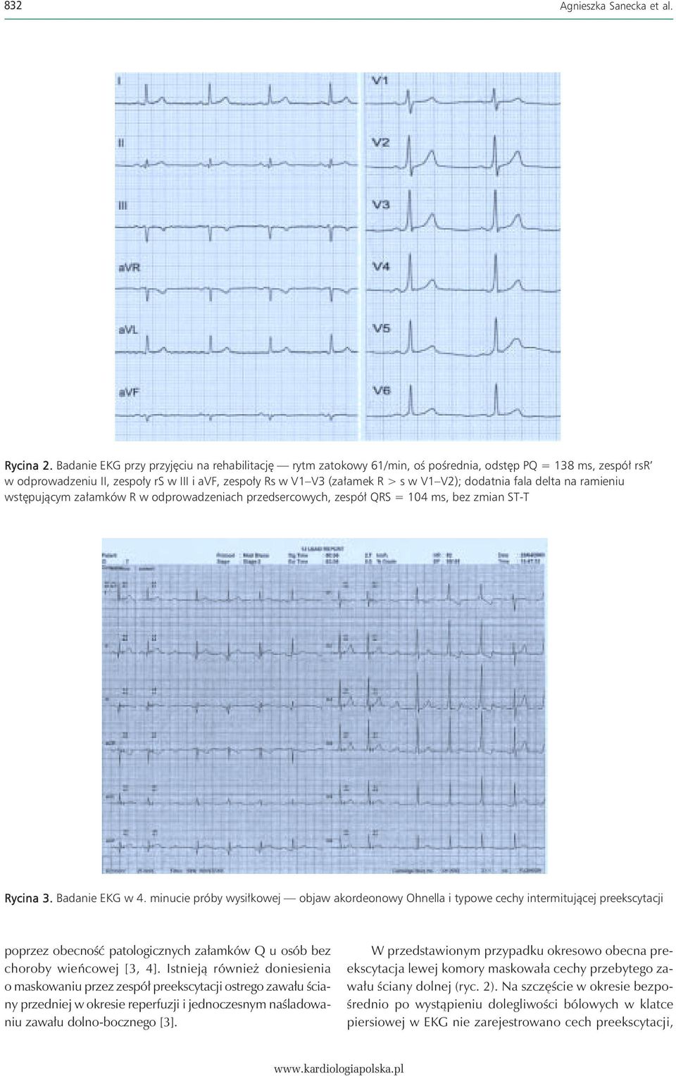 dodatnia fala delta na ramieniu wstępującym załamków R w odprowadzeniach przedsercowych, zespół QRS = 104 ms, bez zmian ST-T Rycina 3. Badanie EKG w 4.