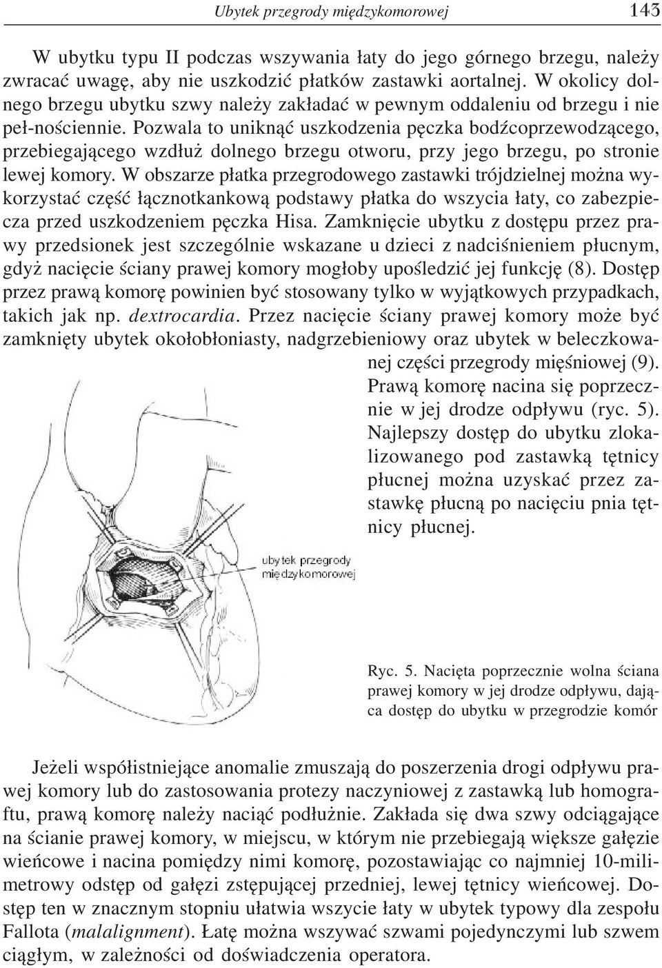 Pozwala to unikn¹æ uszkodzenia pêczka bodÿcoprzewodz¹cego, przebiegaj¹cego wzd³u dolnego brzegu otworu, przy jego brzegu, po stronie lewej komory.