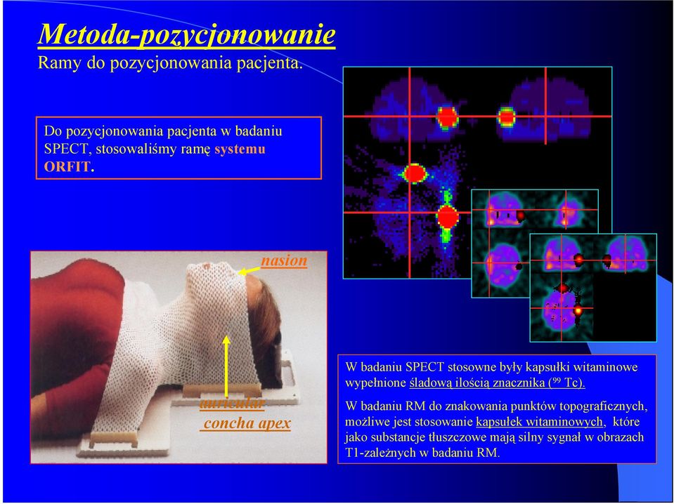 nasion auricular concha apex W badaniu SPECT stosowne były kapsułki witaminowe wypełnione śladową ilością