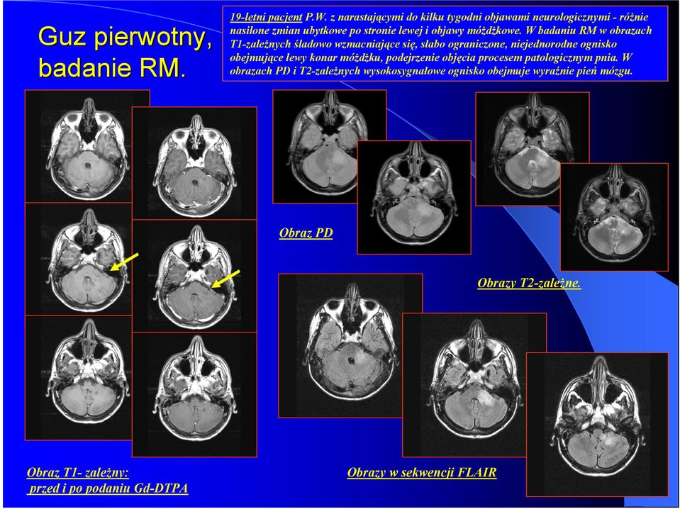 W badaniu RM w obrazach T1-zależnych śladowo wzmacniające się, słabo ograniczone, niejednorodne ognisko obejmujące lewy konar móżdżku,