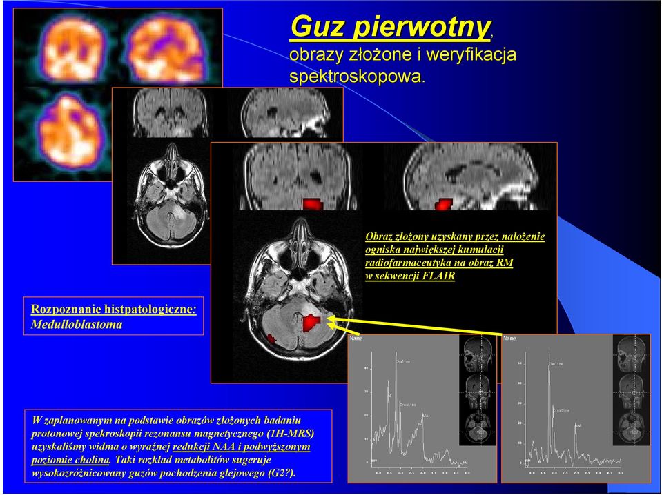 Rozpoznanie histpatologiczne: Medulloblastoma W zaplanowanym na podstawie obrazów złożonych badaniu protonowej spekroskopii