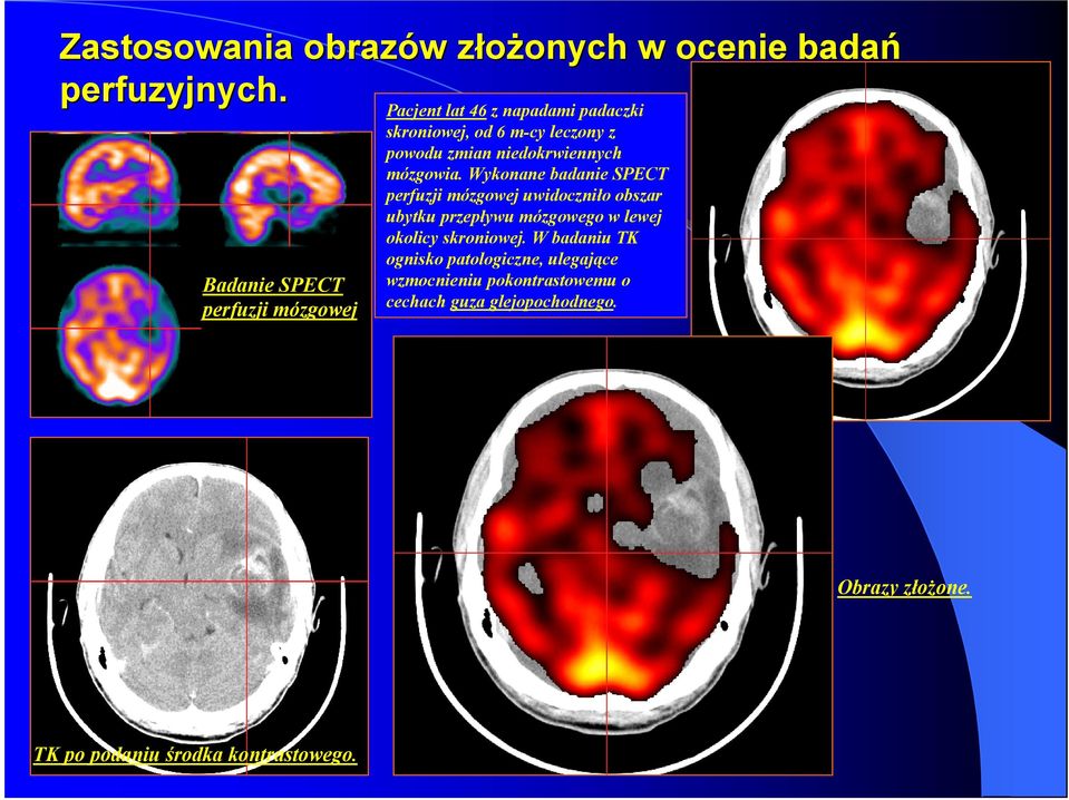 niedokrwiennych mózgowia.