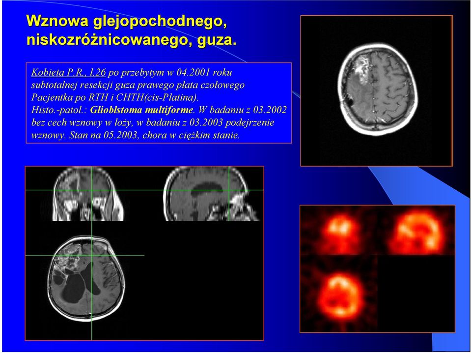 2001 roku subtotalnej resekcji guza prawego płata czołowego Pacjentka po RTH i