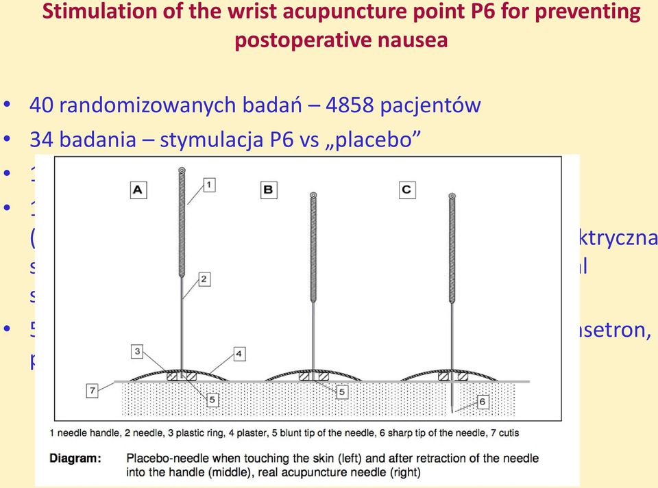 ASP (acupuncture semi-permanent), infiltracja dekstrozą, elektryczna stymulacja igły, TENS, stymulacja laserowa, ETS (electrical