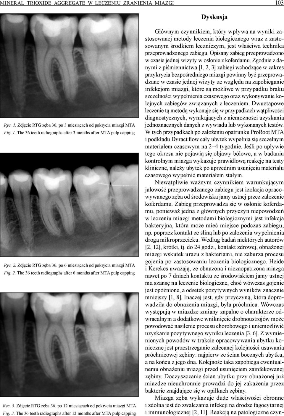 3. The 36 teeth radiographs after 12 months after MTA pulp capping Głównym czynnikiem, który wpływa na wyniki zastosowanej metody leczenia biologicznego wraz z zastosowanym środkiem leczniczym, jest