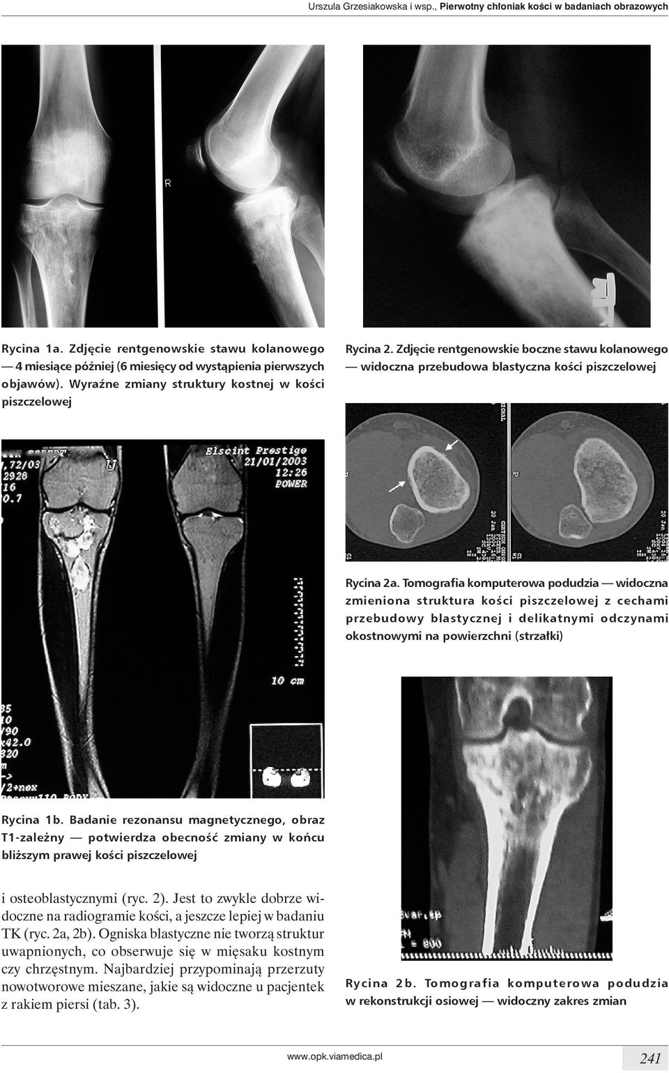 Tomografia komputerowa podudzia widoczna zmieniona struktura kości piszczelowej z cechami przebudowy blastycznej i delikatnymi odczynami okostnowymi na powierzchni (strzałki) Rycina 1b.