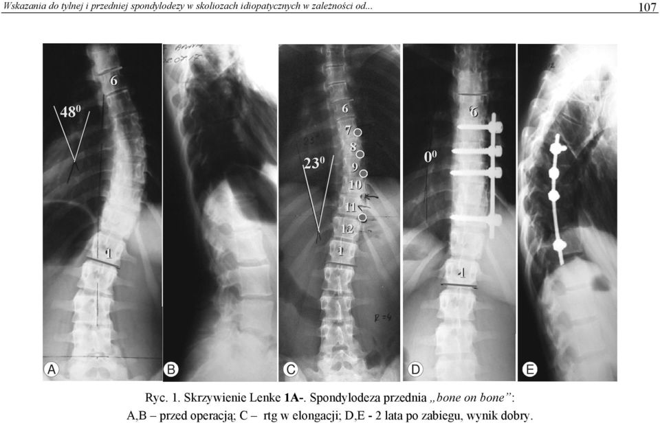 .. 7 6 8 0 23 0 6 7 8 9 0 0 6 11 12 1 1 1 A B C D E Ryc. 1. Skrzywienie Lenke 1A-.