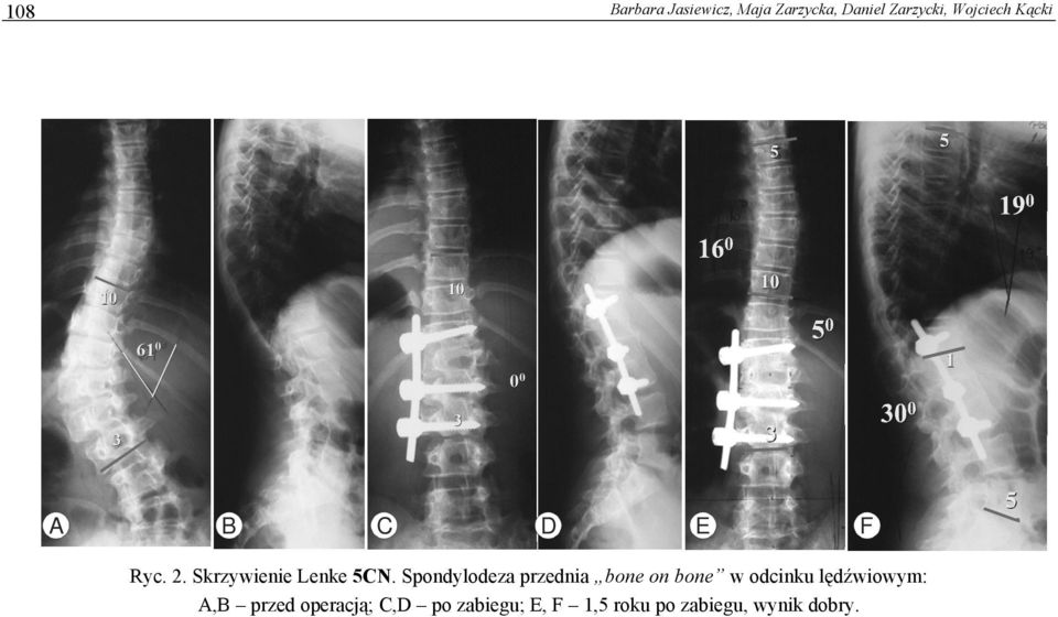 Spondylodeza przednia bone on bone w odcinku lędźwiowym: A,B