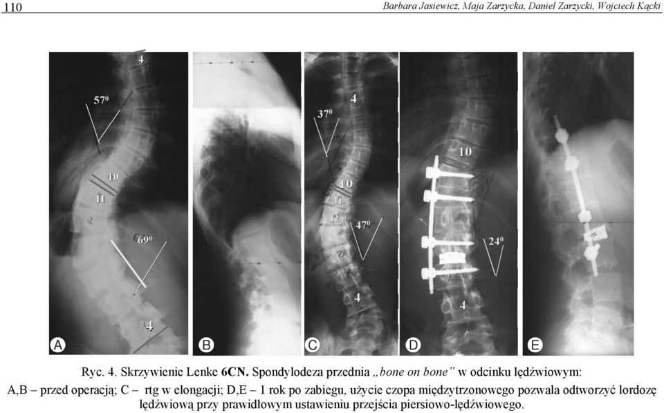 Spondylodeza przednia bone on bone w odcinku lędźwiowym: A,B przed operacją; C rtg w elongacji;