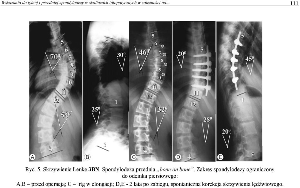 . Skrzywienie Lenke 3BN. Spondylodeza przednia bone on bone.