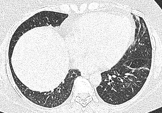 4.2.3 Badania obrazowe i czynnościowe układu oddechowego. 4.2.3.1 Włóknienie śródmiąższowe płuc Włóknienie śródmiąższowe płuc stwierdzono u 31 osób, co stanowi większość chorych (ryc. 15). Rycina 15.