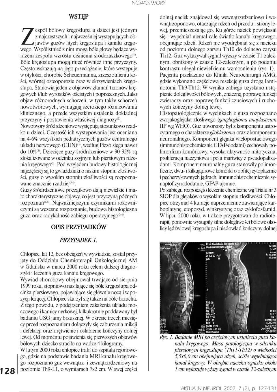 Czêsto wskazuj¹ na jego przeci¹ enie, które wystêpuje w oty³oœci, chorobie Scheuermanna, zrzeszotnieniu koœci, wtórnej osteoporozie oraz w skrzywieniach krêgos³upa.