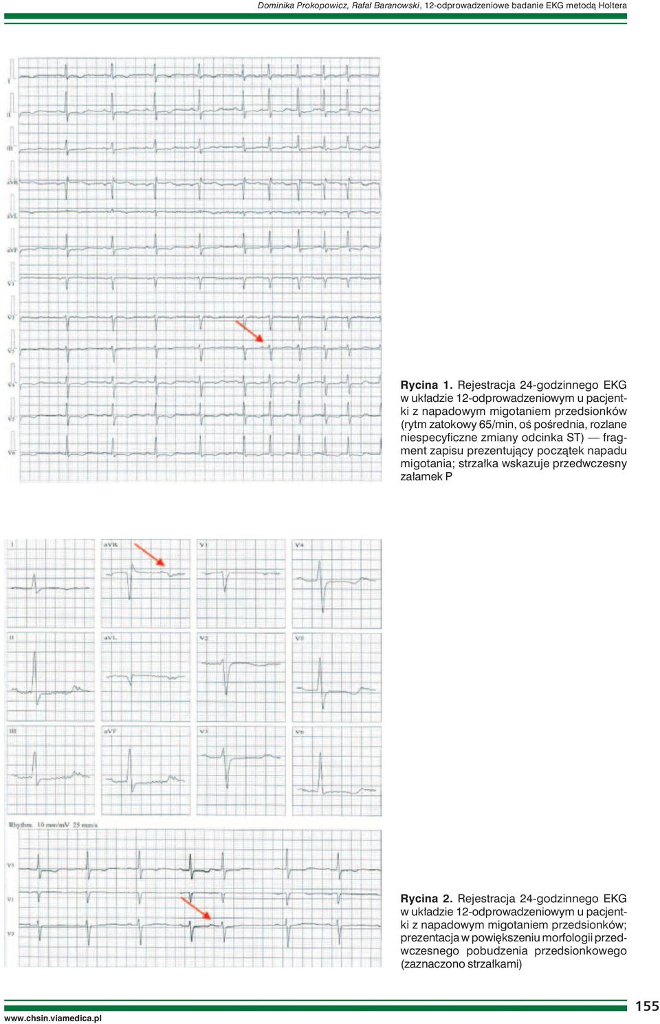 rozlane niespecyficzne zmiany odcinka ST) fragment zapisu prezentujący początek napadu migotania; strzałka wskazuje przedwczesny załamek P Rycina 2.