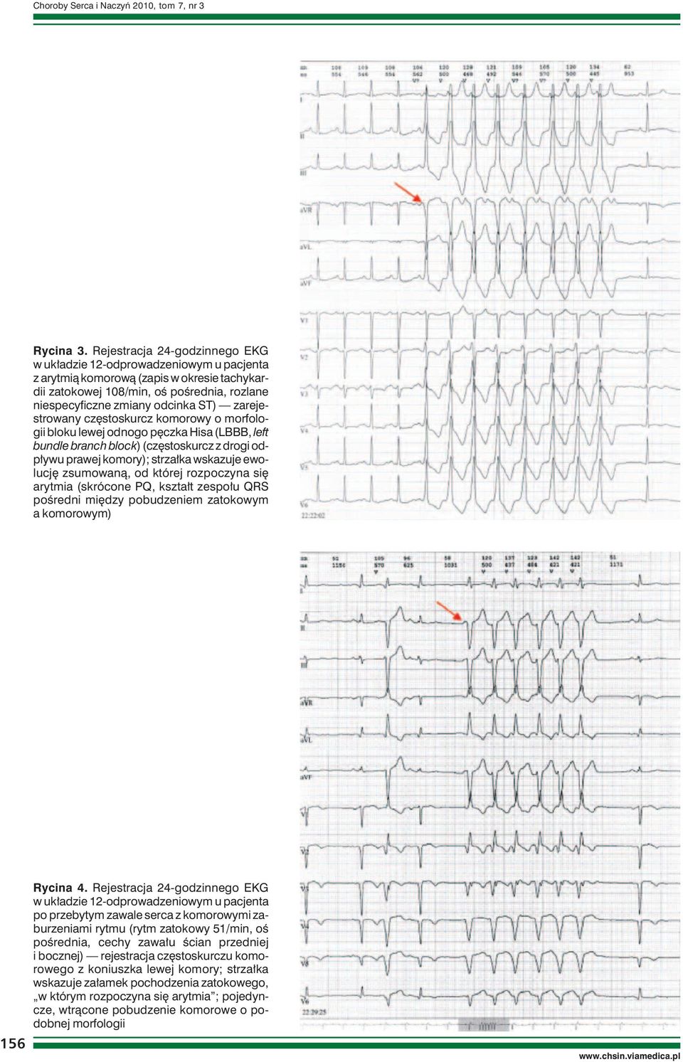 zarejestrowany częstoskurcz komorowy o morfologii bloku lewej odnogo pęczka Hisa (LBBB, left bundle branch block) (częstoskurcz z drogi odpływu prawej komory); strzałka wskazuje ewolucję zsumowaną,