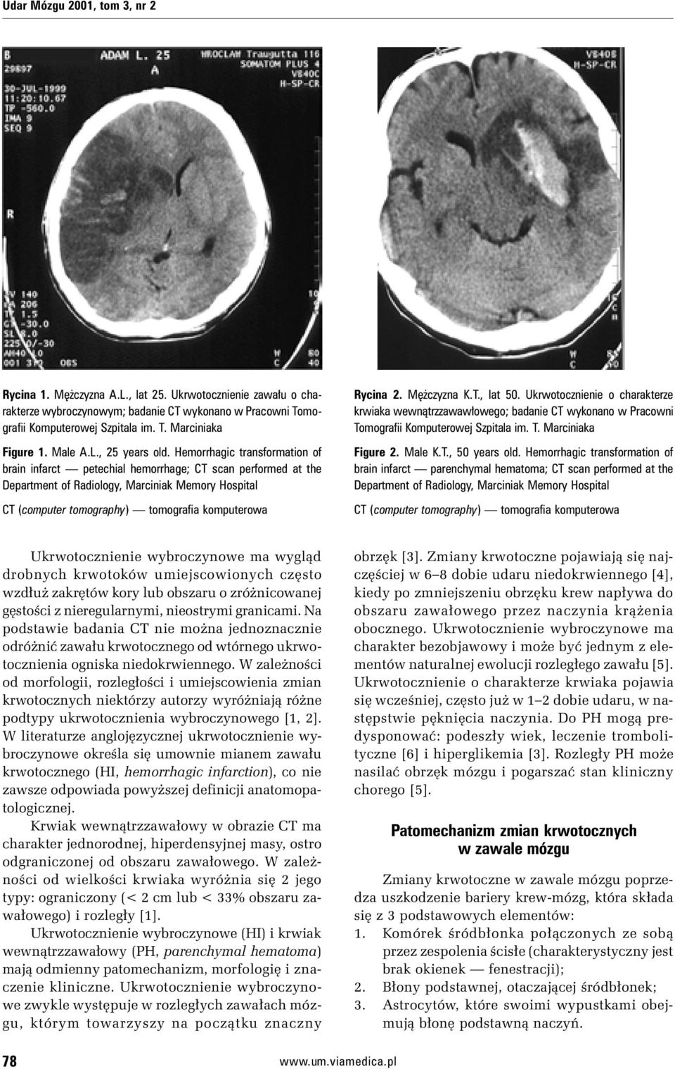 Hemorrhagic transformation of brain infarct petechial hemorrhage; CT scan performed at the Department of Radiology, Marciniak Memory Hospital CT (computer tomography) tomografia komputerowa Rycina 2.