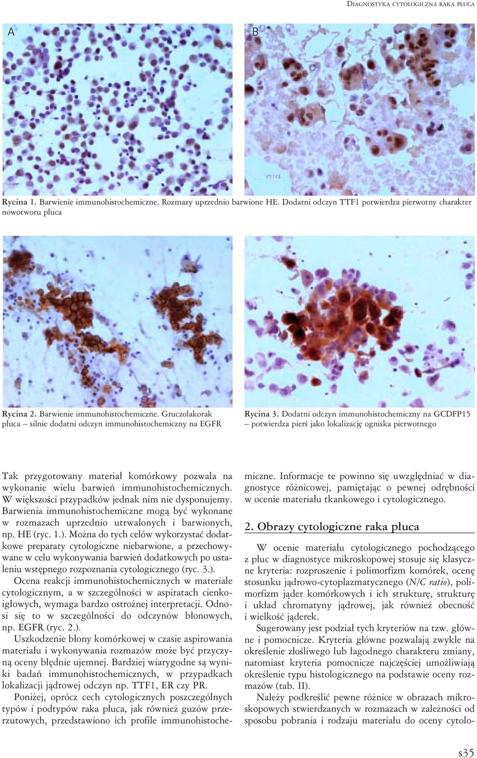 Dodatni odczyn immunohistochemiczny na GCDFP15 potwierdza pierś jako lokalizację ogniska pierwotnego Tak przygotowany materiał komórkowy pozwala na wykonanie wielu barwień immunohistochemicznych.