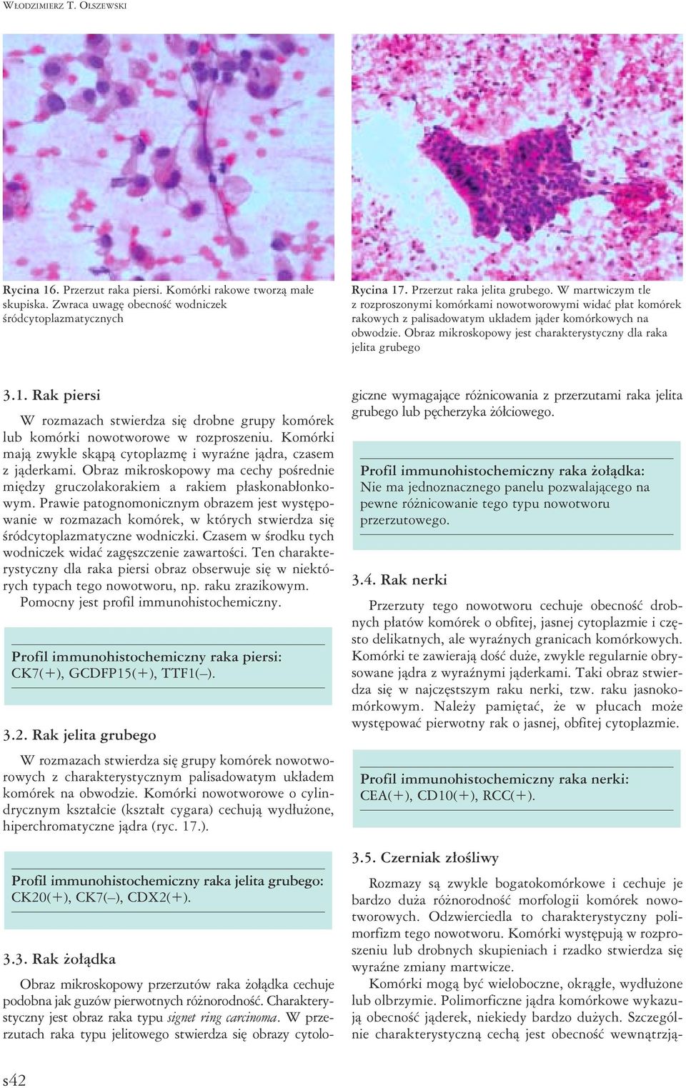 Obraz mikroskopowy jest charakterystyczny dla raka jelita grubego 3.1. Rak piersi W rozmazach stwierdza się drobne grupy komórek lub komórki nowotworowe w rozproszeniu.