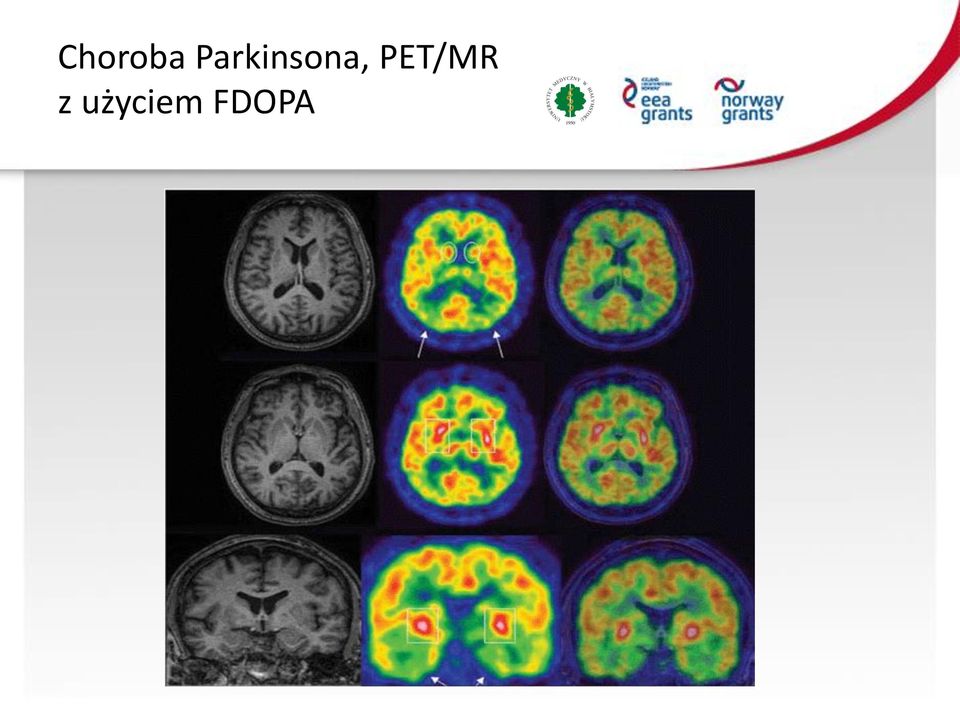 Brain 18F-FDG PET-MRI