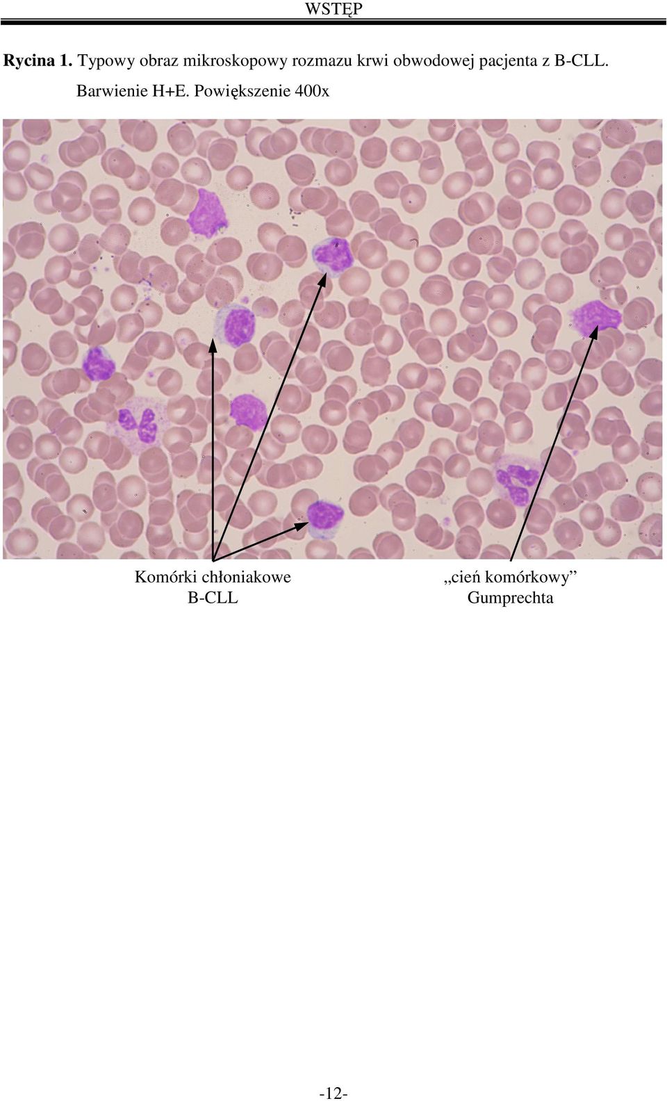 obwodowej pacjenta z B-CLL. Barwienie H+E.