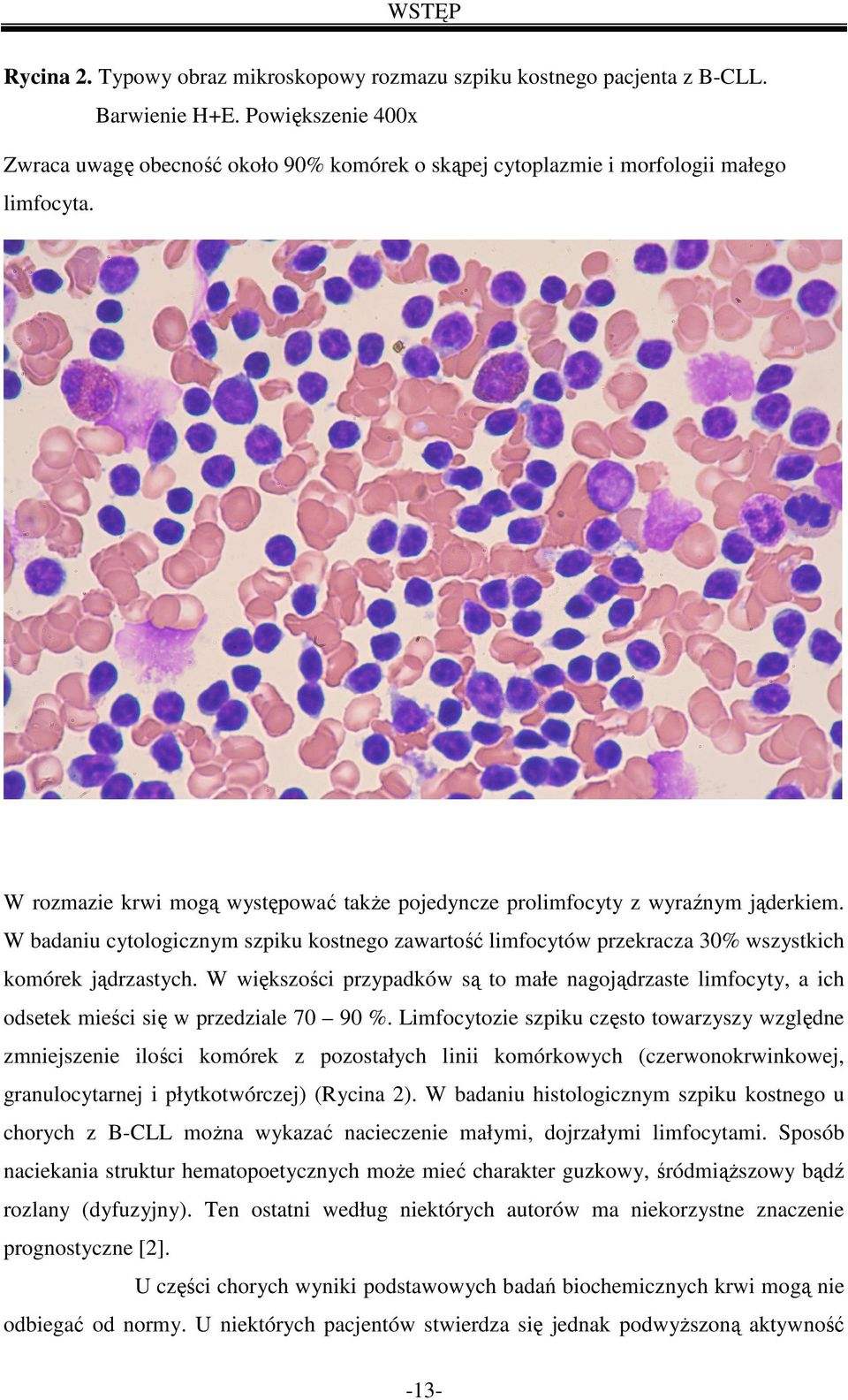 W badaniu cytologicznym szpiku kostnego zawartość limfocytów przekracza 30% wszystkich komórek jądrzastych.