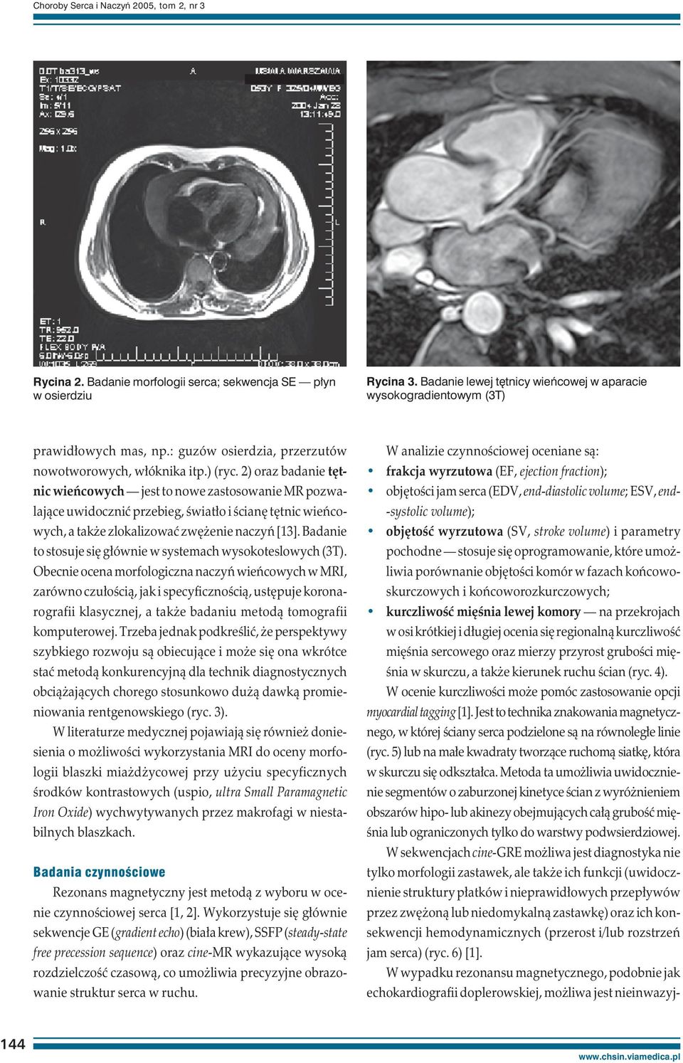 2) oraz badanie tętnic wieńcowych jest to nowe zastosowanie MR pozwalające uwidocznić przebieg, światło i ścianę tętnic wieńcowych, a także zlokalizować zwężenie naczyń [13].