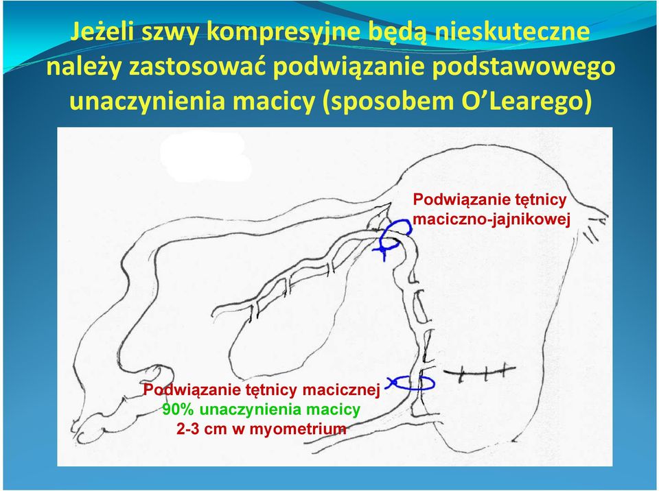 Learego) Podwiązanie tętnicy maciczno-jajnikowej