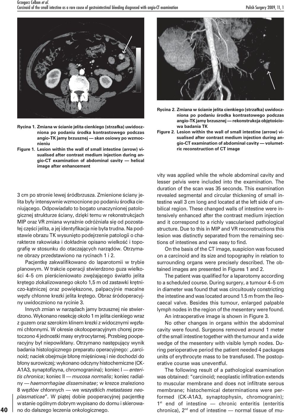 Lesion within the wall of small intestine (arrow) visualised after contrast medium injection during angio-ct examination of abdominal cavity helical image after enhancement 3 cm po stronie lewej