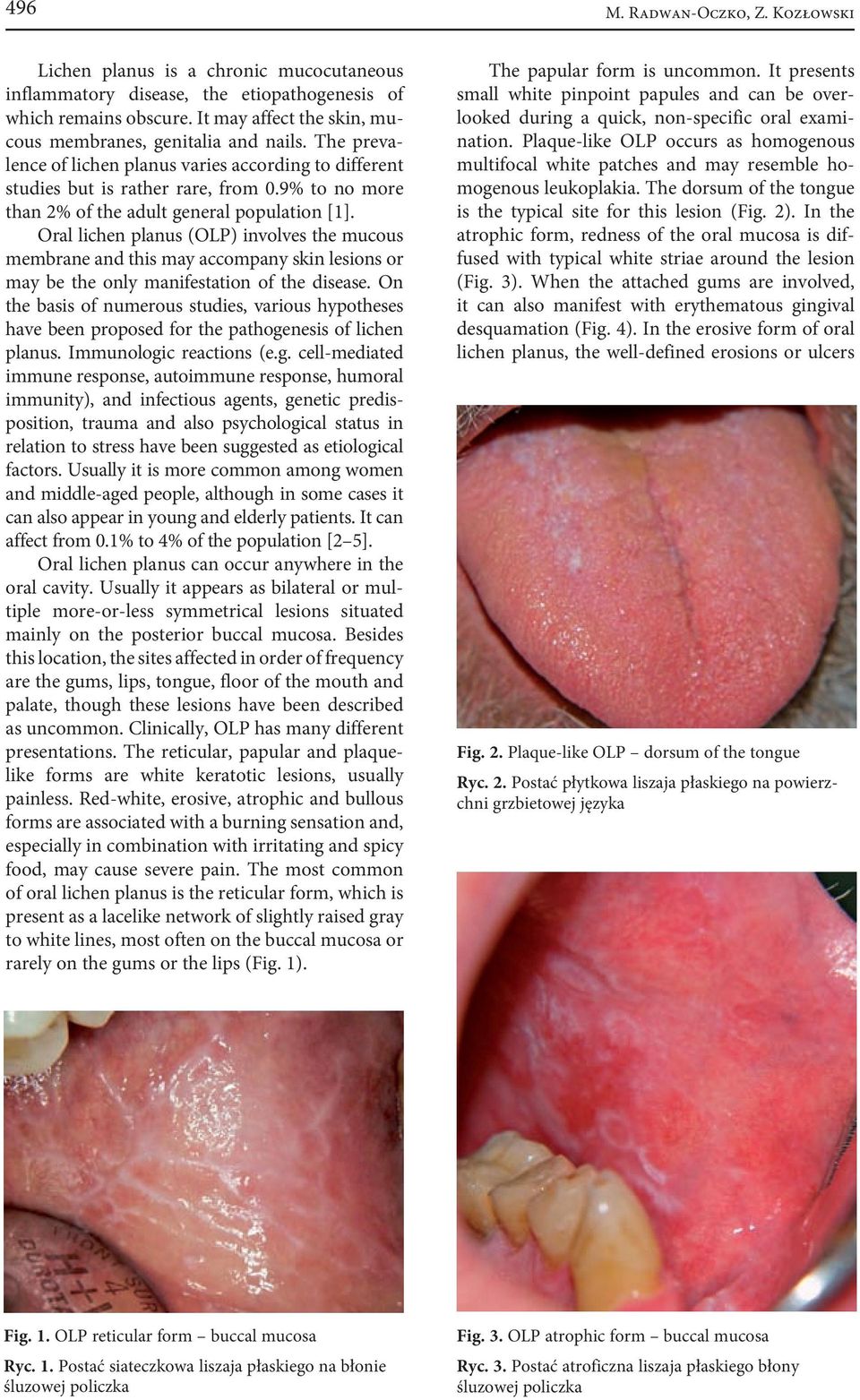 9% to no more than 2% of the adult general population [1]. Oral lichen planus (OLP) involves the mucous membrane and this may accompany skin lesions or may be the only manifestation of the disease.