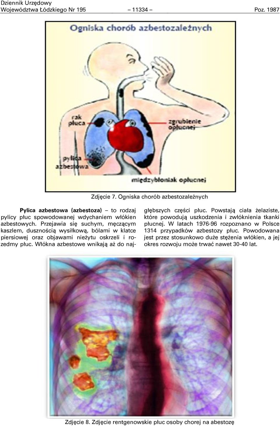 Przejawia siĉ suchym, mĉczącym kaszlem, dusznością wysiłkową, bólami w klatce piersiowej oraz objawami nieşytu oskrzeli i rozedmy płuc.