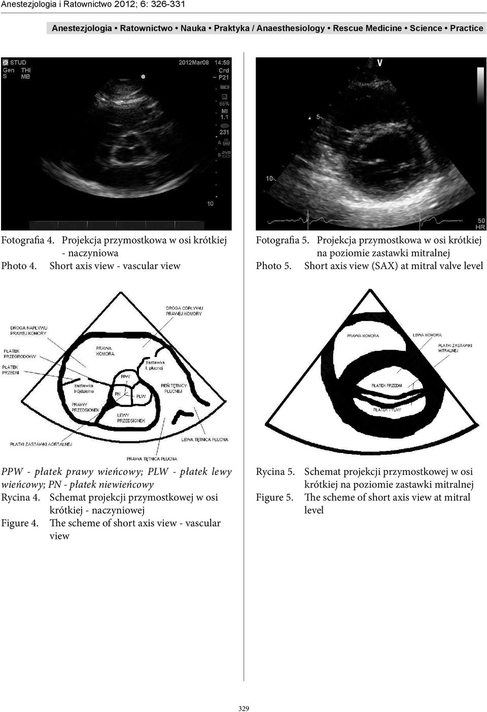 Short axis view (SAX) at mitral valve level PPW - płatek prawy wieńcowy; PLW - płatek lewy wieńcowy; PN - płatek niewieńcowy Rycina 4.