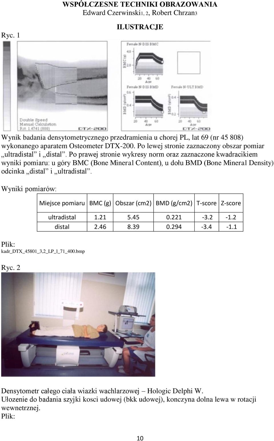 Po prawej stronie wykresy norm oraz zaznaczone kwadracikiem wyniki pomiaru: u góry BMC (Bone Mineral Content), u dołu BMD (Bone Mineral Density) odcinka distal i ultradistal.