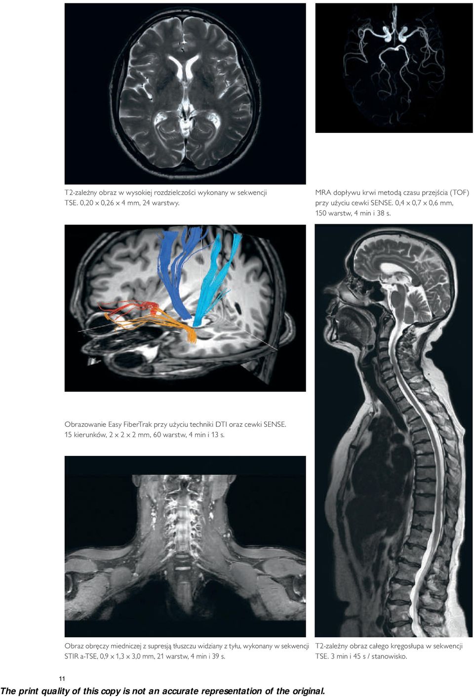 Obrazowanie Easy FiberTrak przy użyciu techniki DTI oraz cewki SENSE. 15 kierunków, 2 x 2 x 2 mm, 60 warstw, 4 min i 13 s.