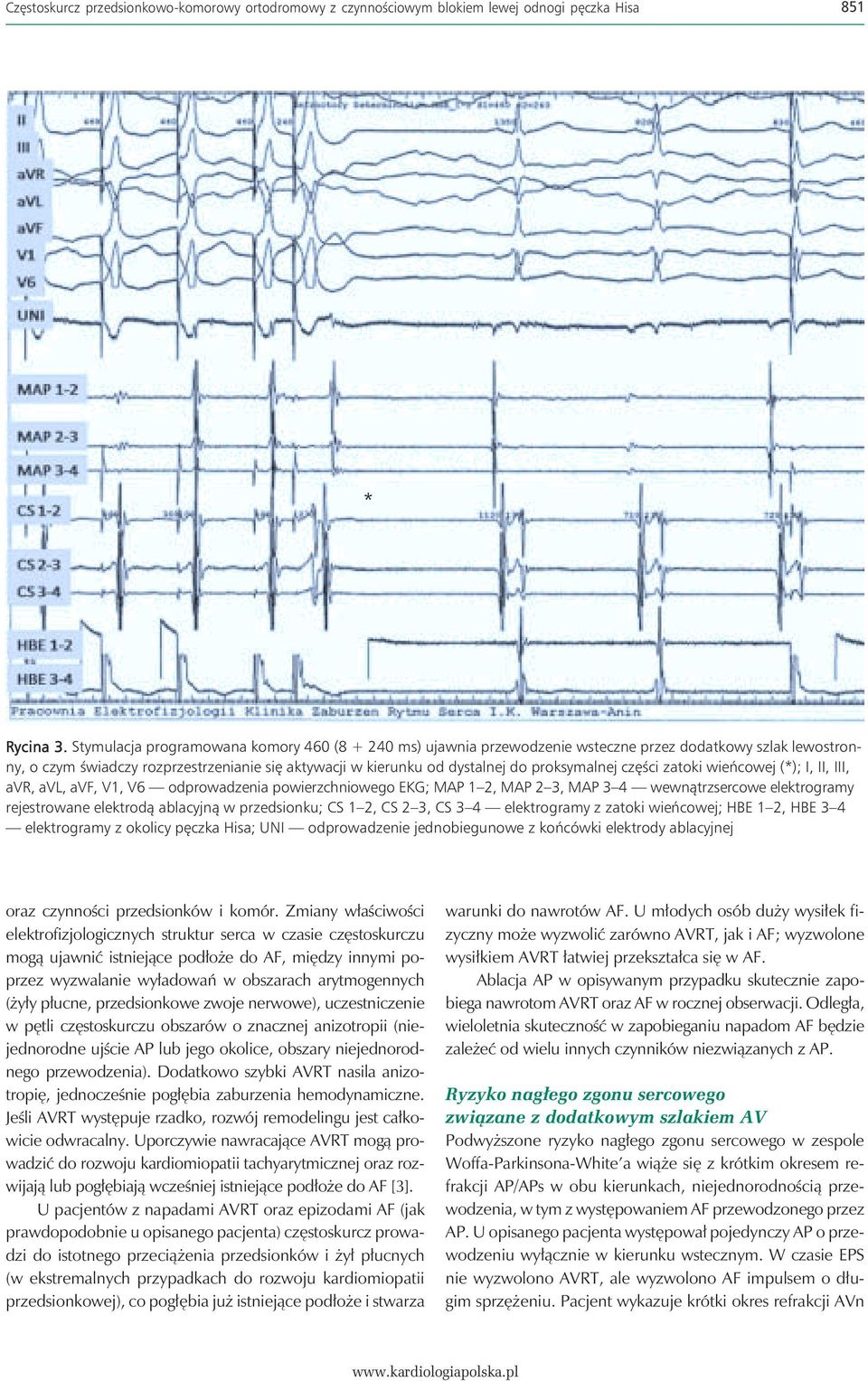 proksymalnej części zatoki wieńcowej (*); I, II, III, avr, avl, avf, V1, V6 odprowadzenia powierzchniowego EKG; MAP 1 2, MAP 2 3, MAP 3 4 wewnątrzsercowe elektrogramy rejestrowane elektrodą ablacyjną