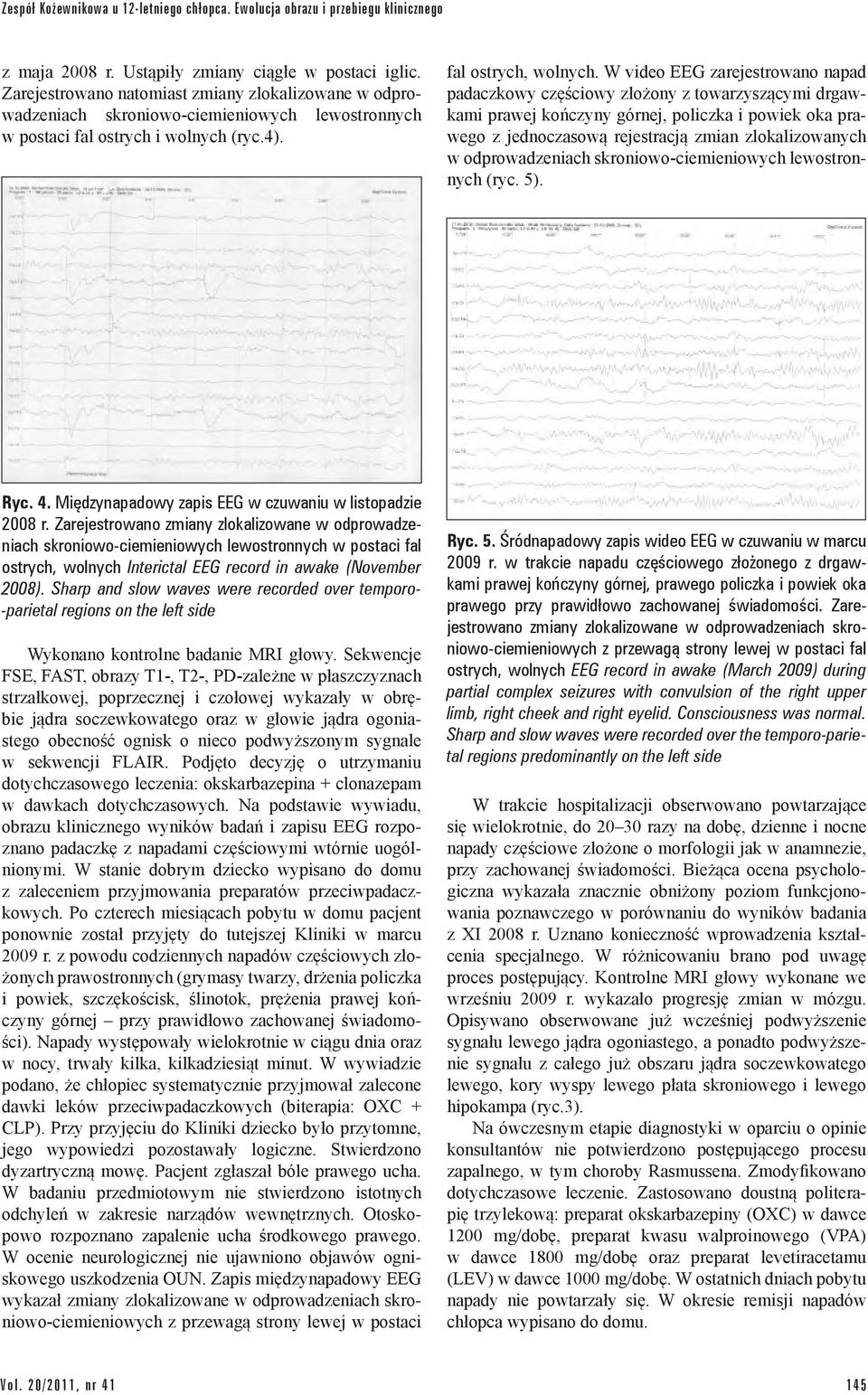 W video EEG zarejestrowano napad padaczkowy częściowy złożony z towarzyszącymi drgawkami prawej kończyny górnej, policzka i powiek oka prawego z jednoczasową rejestracją zmian zlokalizowanych w