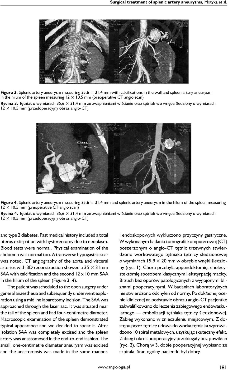 Tętniak o wymiarach 35,6 31,4 mm ze zwapnieniami w ścianie oraz tętniak we wnęce śledziony o wymiarach 12 10,5 mm (przedoperacyjny obraz angio-ct) Figure 4. Splenic artery aneurysm measuring 35.6 31.4 mm and splenic artery aneurysm in the hilum of the spleen measuring 12 10.