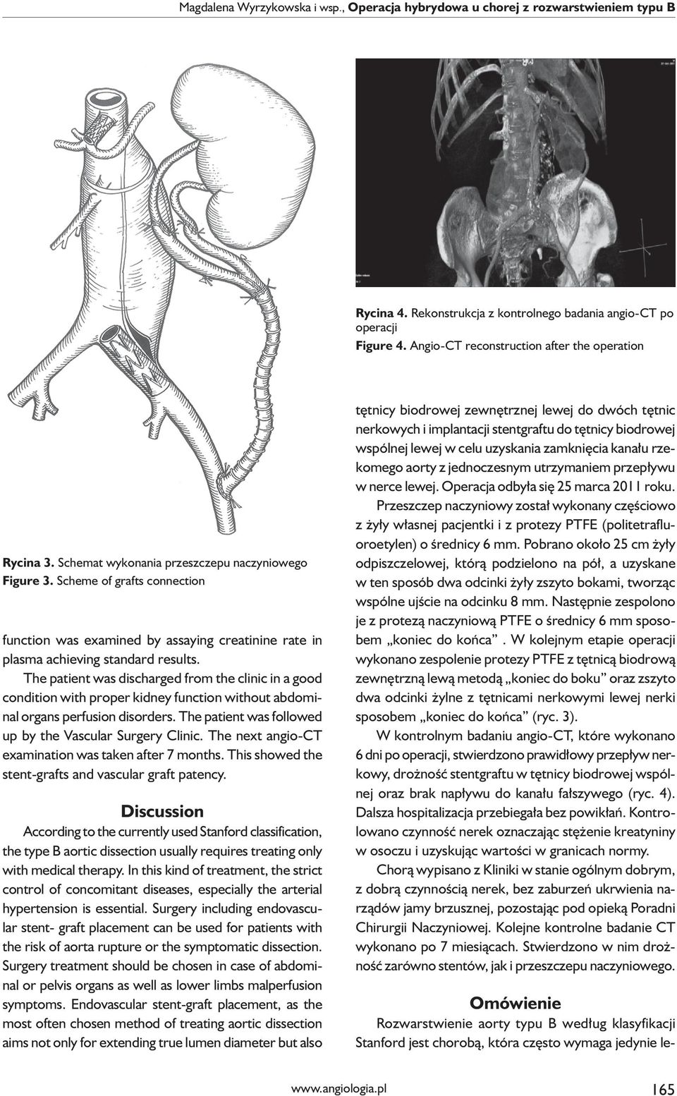 Scheme of grafts connection Omówienie Rozwarstwienie aorty typu B według klasyfikacji Stanford jest chorobą, która często wymaga jedynie lefunction was examined by assaying creatinine rate in plasma