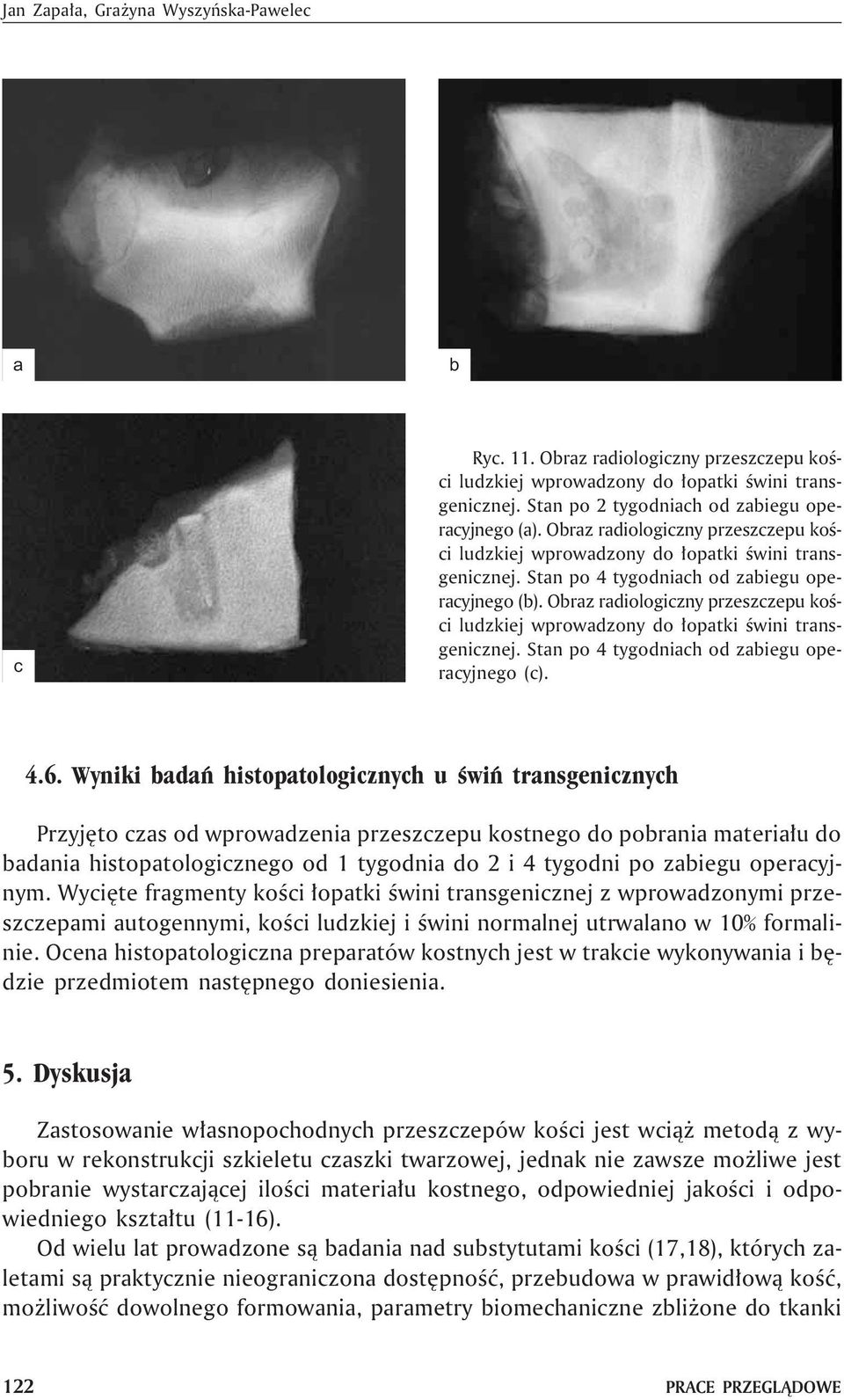 Orz rdiologiczny przeszczepu koœci ludzkiej wprowdzony do ³optki œwini trnsgenicznej. Stn po 4 tygodnich od ziegu opercyjnego (c). 4.6.