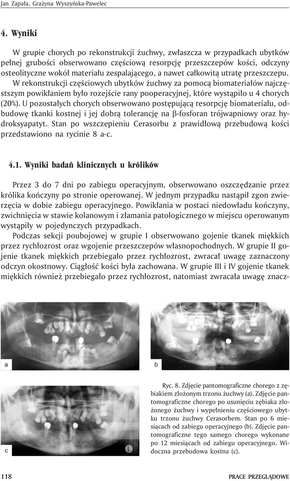 c³kowit¹ utrtê przeszczepu. W rekonstrukcji czêœciowych uytków uchwy z pomoc¹ iomteri³ów njczêstszym powik³niem y³o rozejœcie rny poopercyjnej, które wyst¹pi³o u 4 chorych (20%).