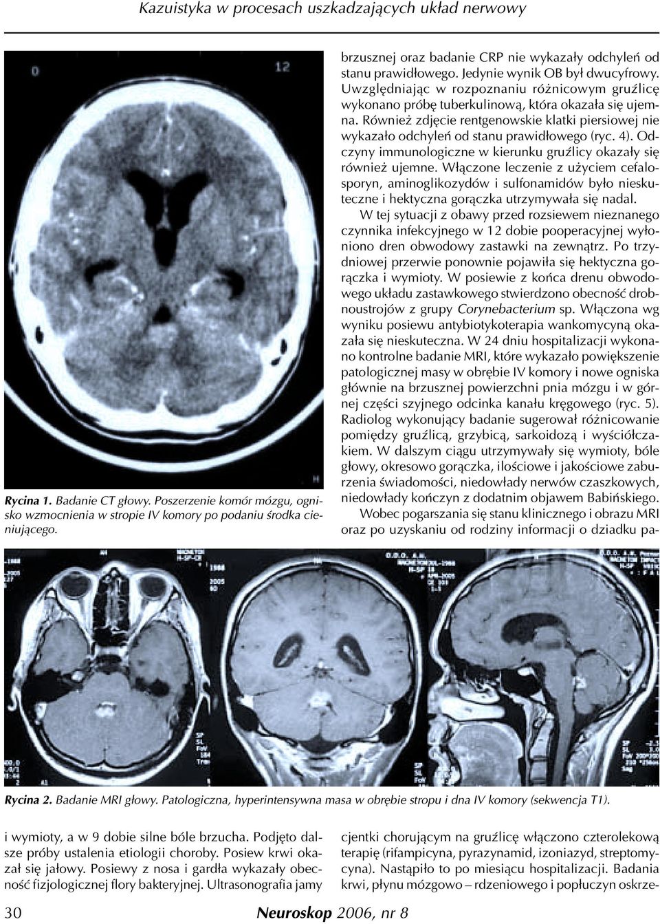 Równie zdjêcie rentgenowskie klatki piersiowej nie wykaza³o odchyleñ od stanu prawid³owego (ryc. 4). Odczyny immunologiczne w kierunku gruÿlicy okaza³y siê równie ujemne.