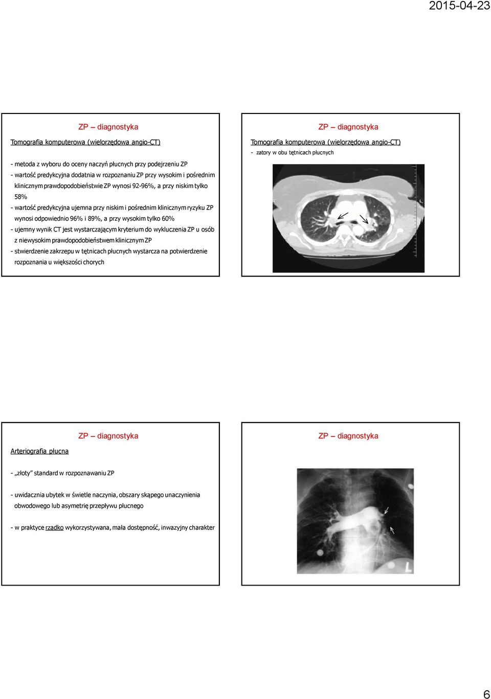 wynik CT jest wystarczającym kryterium do wykluczenia ZP u osób z niewysokim prawdopodobieństwem klinicznym ZP - stwierdzenie zakrzepu w tętnicach płucnych wystarcza na potwierdzenie rozpoznania u