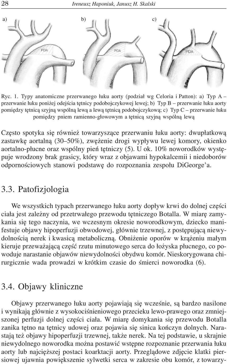 Na tej podstawie, u skrajnie niewydolnego noworodka mo na postawiæ wstêpne rozpoznanie przerwania ³uku aorty lub najciê szej postaci koarktacji aorty.